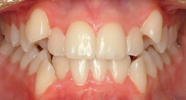 Dry Sockets Demystified: Understanding the Connection to Tooth Extraction -  Leadseuth